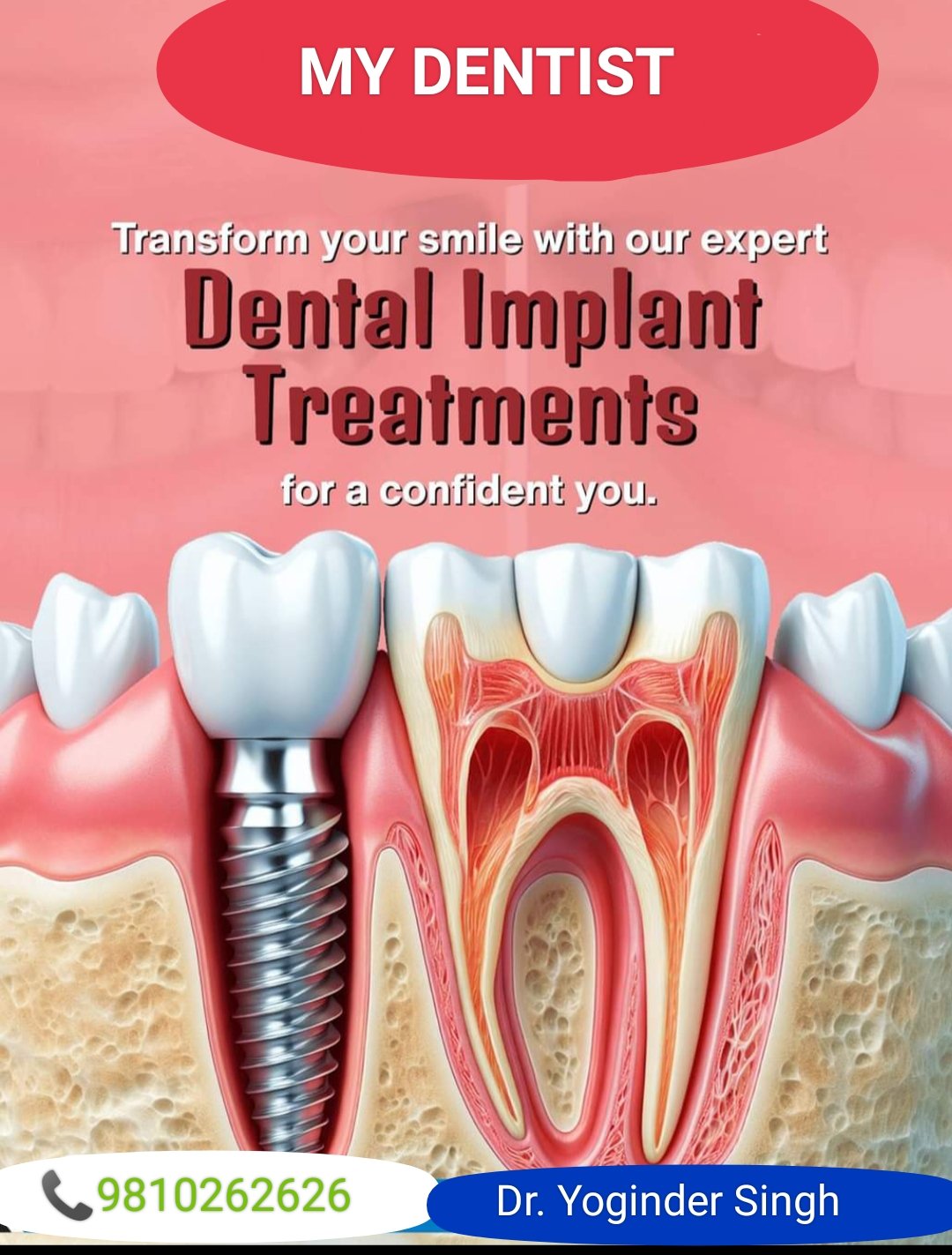 Diagram of dental implant procedure in jawbone