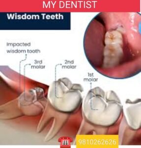 Dentist extracting a wisdom tooth at my dentist dental clinic