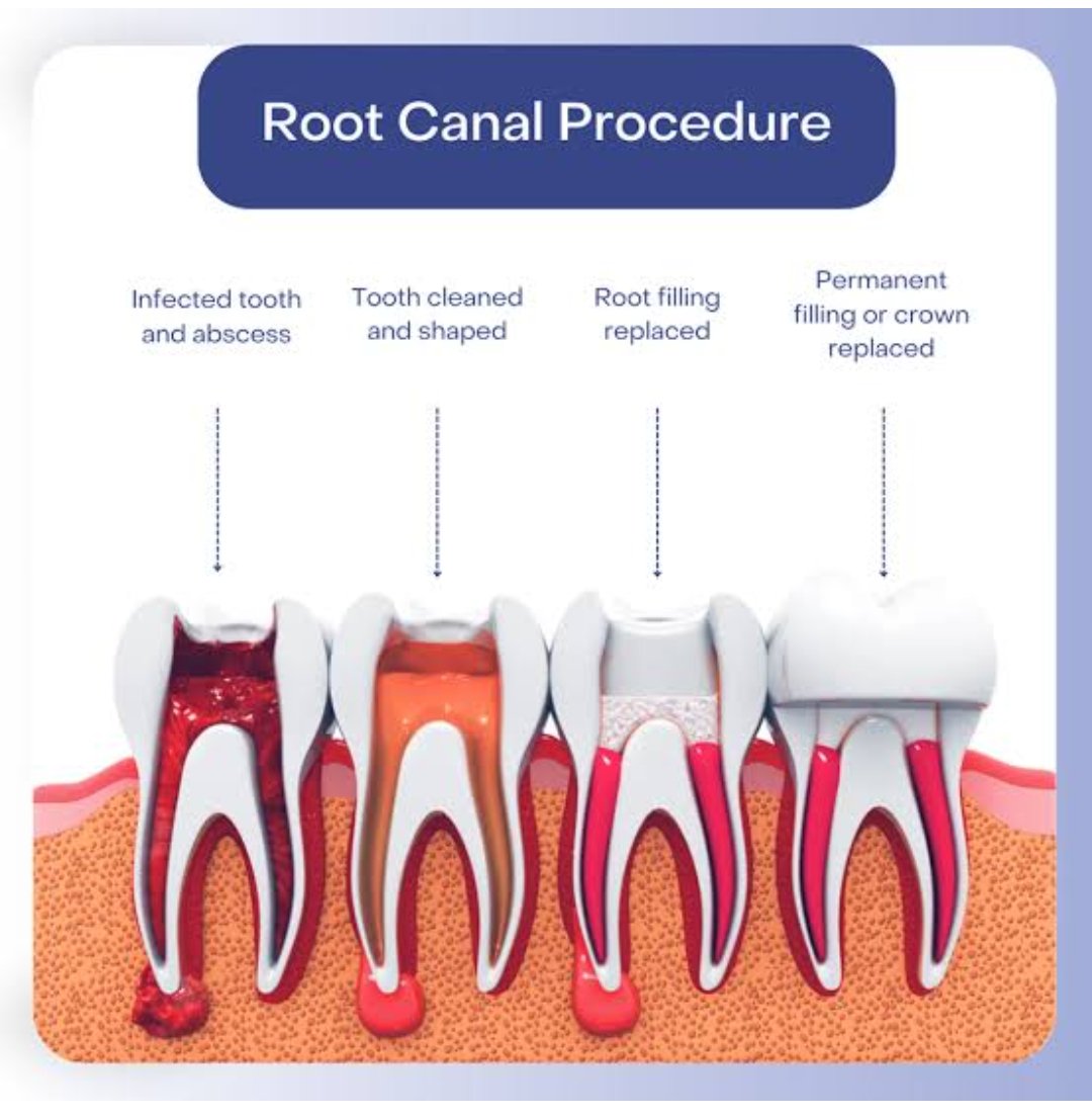Illustration showing step-by-step root canal treatment procedure in dental clinic.