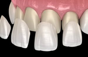 Close-up of a bright, natural smile with porcelain veneers