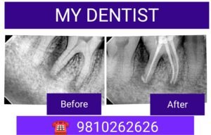 root canal treatment near me
