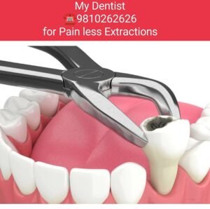 complete guide to tooth removal